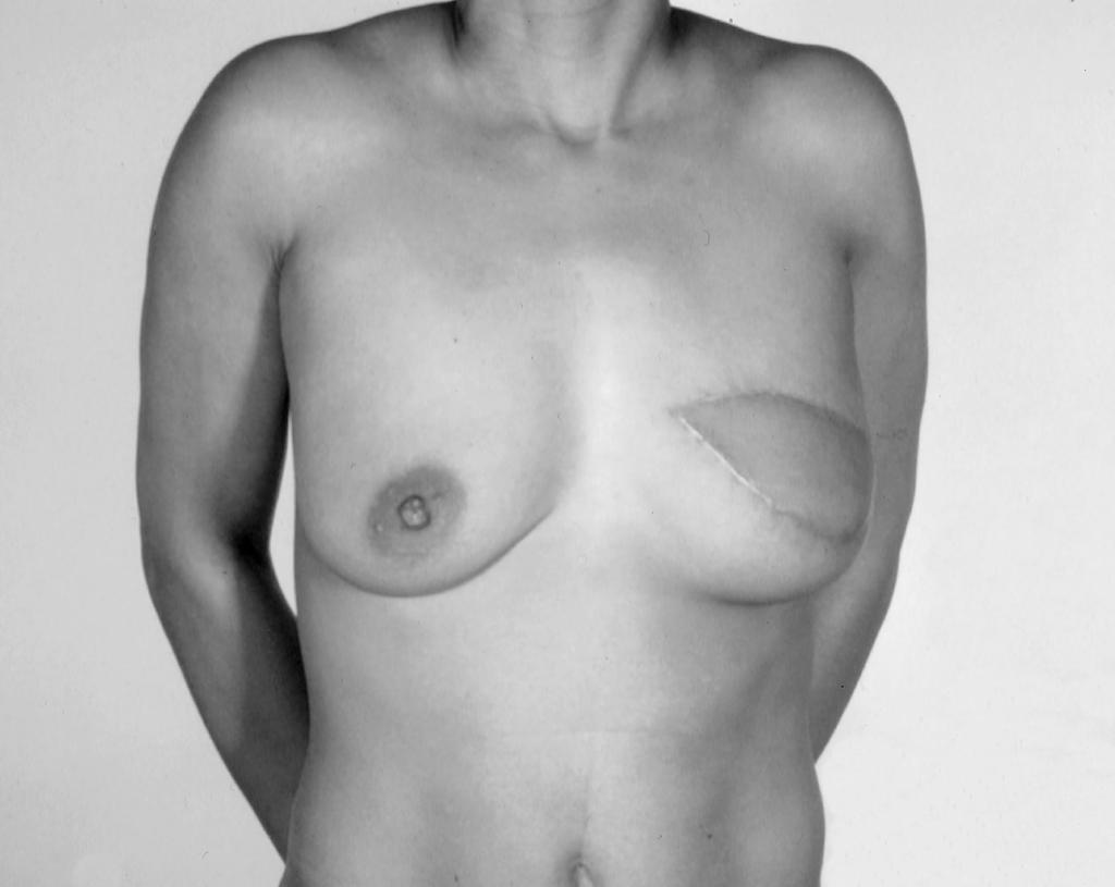 However, their study is handicapped because, to simulate scars, lines were drawn on normal breasts with intact areolar complexes. These were then used as a scar comparison.