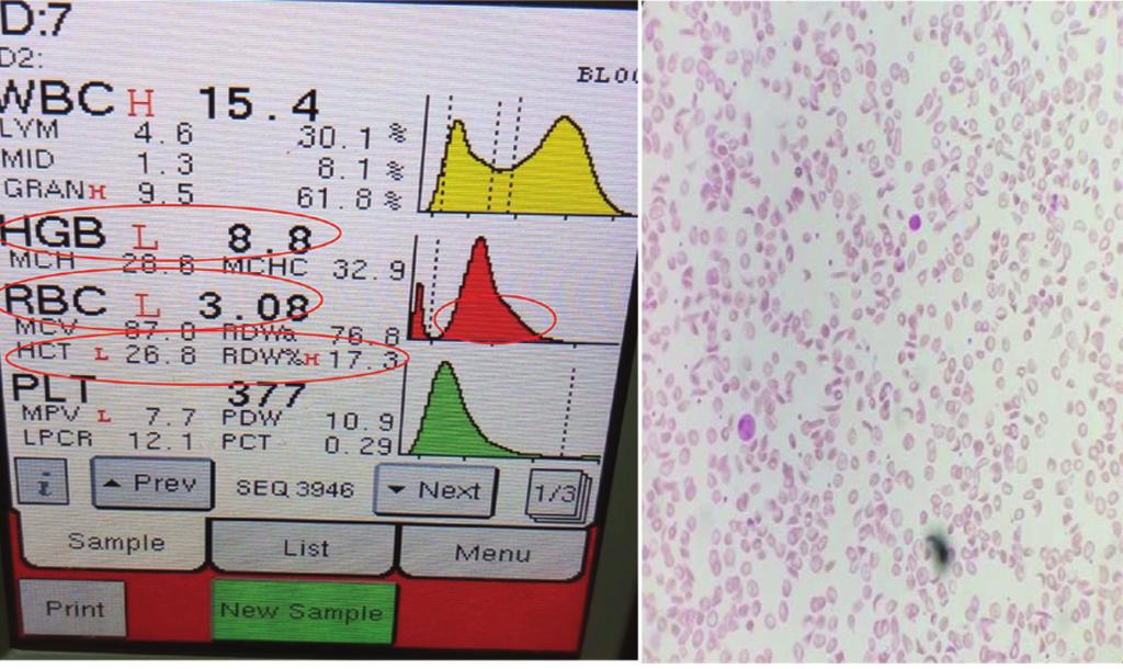 Image 5: Rbc Histogram Showing Short Peak, Broad Base And Peripheral Smear Of Sickle Cell Anemia (40x) A histogram can provide useful information for laboratories in: 1) Monitoring the reliability of