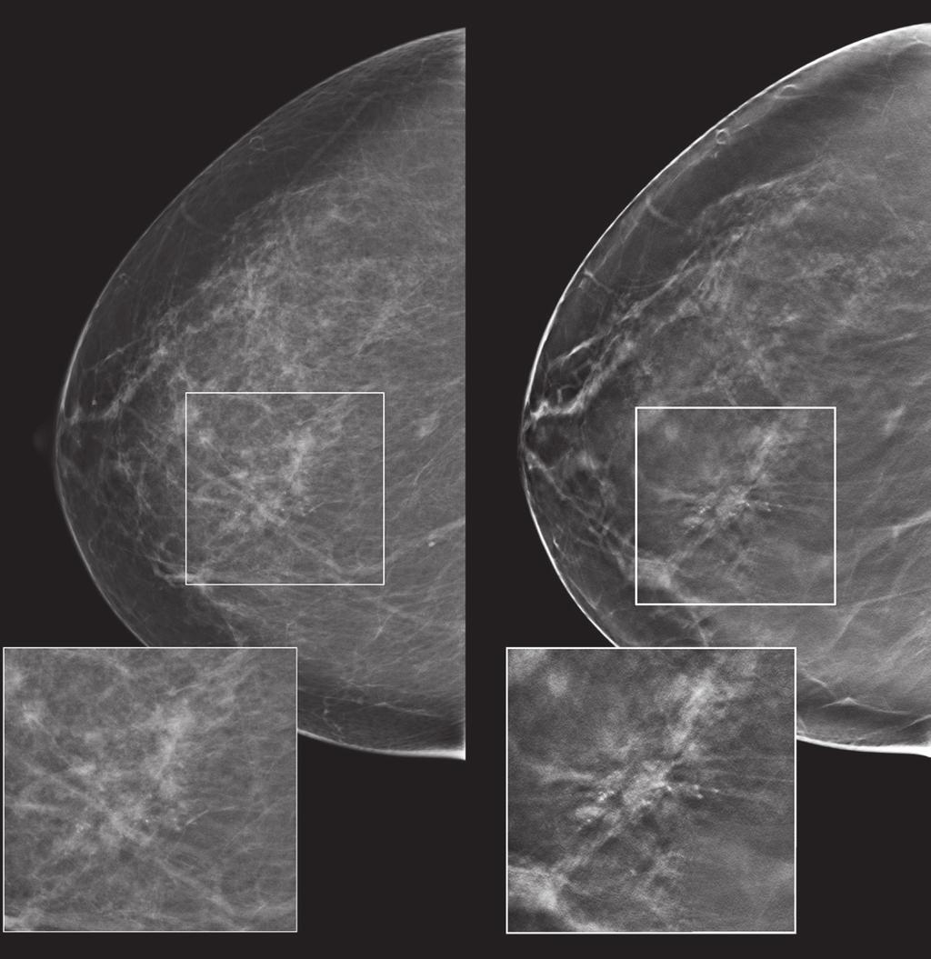 2D Tomo ADDED VALUE FOR CALCIFICATIONS: The 2D mammogram on the left shows right medial microcalcifications.