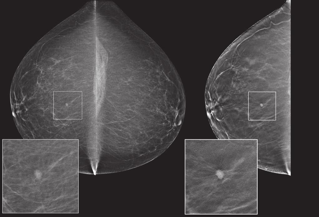 (Diagnosis: Ductal Carcinoma In-situ/High Grade) BI-RADS density 1 and 2 and dense breasts were defined as BI-RADS density 3 and 4.