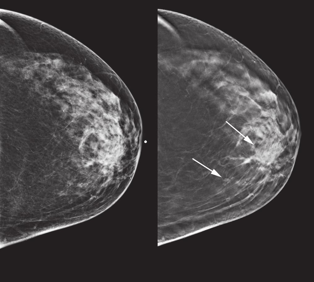 clinical research will be needed to identify the respective roles of tomosynthesis and ultrasound, particularly in screening women with dense breasts.