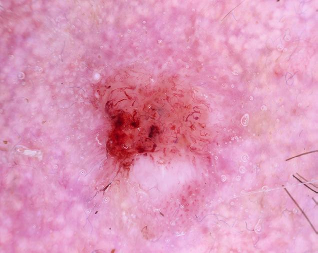 Dermatoscopy of a moderately differentiated SCC on the temple; flat pink central area with peripheral pink and white areas displaying asymmetric spatial distribution, bizarre vessel forms, numerous