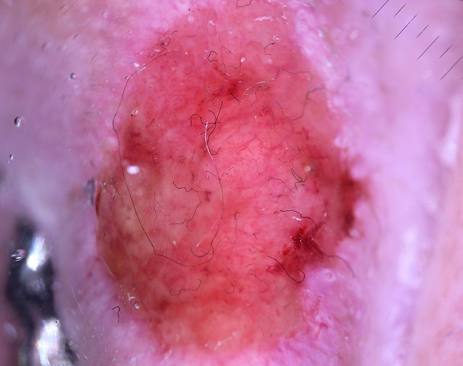 Dermatoscopy of a poorly differentiated SCC on the ear; the tumor surface follows the cartilage contours; pink areas cover the whole tumor surface; branching vessels without a white halo are common.