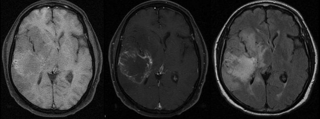 Fig 1. Patient 1. Glioblastoma multiforme: T1 before and after IV contrast injection and FLAIR before contrast. Fig 2. Patient 1. Multivoxel 1 H-MR spectroscopy covering the largest area of the tumor and the spectra obtained before and after IV contrast injection in the medial margin of the tumor.