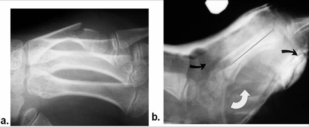 10 3. Fractures of the metacarpal shaft a. These are usually green stick apex dorsal. b.