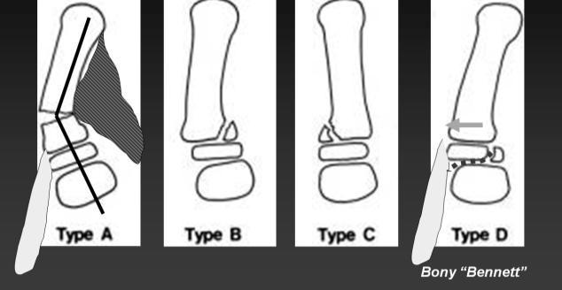 f. Thumb metacarpal fractures 1. Proximal Physeal Fractures Thumb metacarpal 11 2.