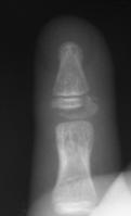 ) Pitfall: Failure to recognize these as an open fracture. d.reverse Mallet pattern 1.