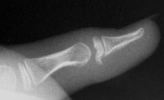 b. AP view shows the fracture involves the epiphysis. c. The fragment reduces in flexion. 2.