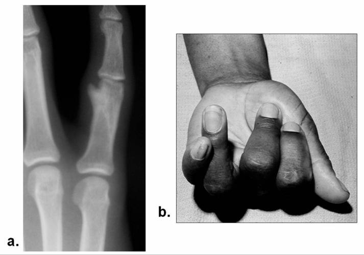. C. Phalangeal shaft fractures 1. Two main fracture patterns. a. Oblique 1.) Can both shorten and rotate.( Fig. 8). Fig.8. Complications of oblique shaft fractures. a. the fracture fragments may shorten.