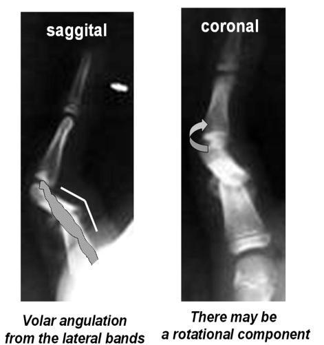 6 Fig.9. Complications of transverse shaft fractures. a. The lateral band shift above the long axis of the phalanx producing palmar angulation. b. In addition, the distal fragment may rotate. 2.