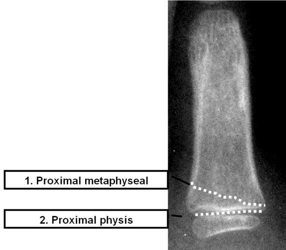 7 Fig.11. Proximal Phalangeal fractures. Fractures of the proximal and middle phalanges usually involve:1. The Metaphysis or 2.