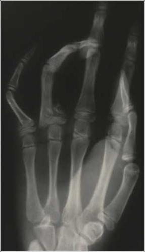 Failure to adequately treat the fracture with residual deformity which can result in a loss of MP motion. II.