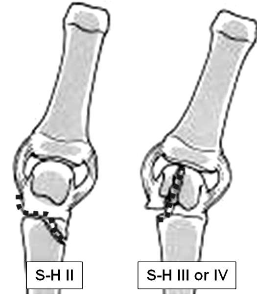 9 1. Fractures of the metacarpal head a. Usually Physeal-Epiphyseal Involvement (Fig.17.). b.