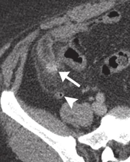 A Shademan and RFR Tappouni Fig. 1. Cecal diverticulitis with and without visualisation of the appendix. Forty-two-yearold man with acute right lower quadrant pain and fever.