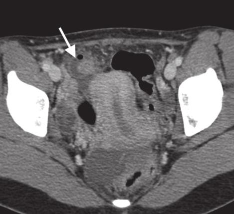 When the appendix is not seen, cecal diverticulitis can be misdiagnosed as acute appendicitis.