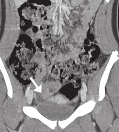 Right-sided colonic diverticulitis is a common clinical mimicker of acute appendicitis that may also be mistaken with appendicitis on CT scan by causing pericolic inflammatory changes and adjacent