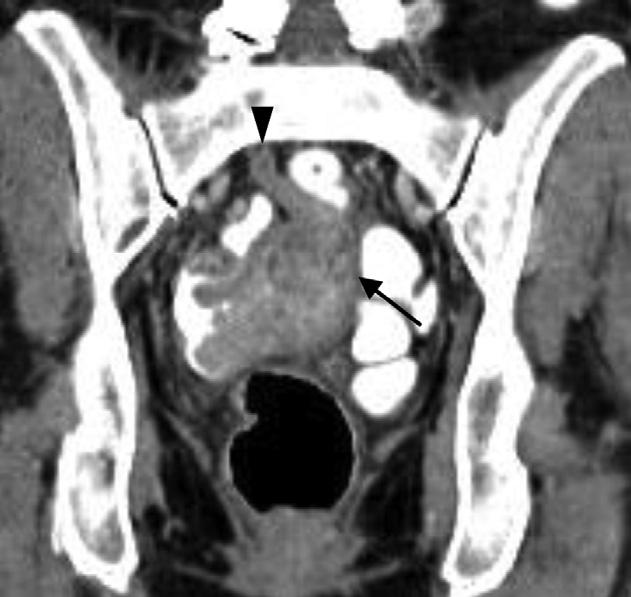 Pitfalls in CT diagnosis of appendicitis Fig. 3. Sixty-eight-year-old woman with large cecal adenocarcinoma with secondary appendiceal obstruction and dilatation.