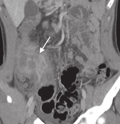 In view of acute right lower quadrant pain, right hemicolectomy was perfumed. Pathology confirmed cecal adenocarcinoma; however, the appendix was dilated without inflammatory changes.
