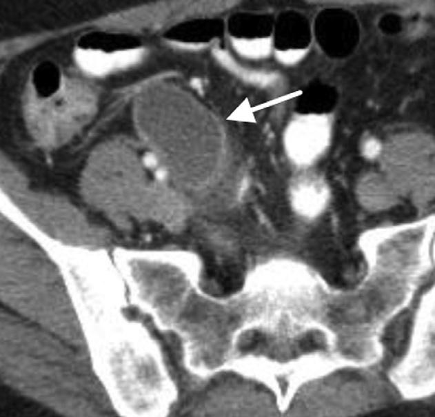 Axial CT with oral and IV contrast shows a dilated large fluid filled appendix (arrow). Peri-appendiceal stranding appears posteriorly, which is an atypical feature of mucinous cystadenoma.