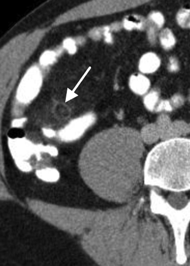 A Shademan and RFR Tappouni Diagnostic dilemmas Equivocal cases of appendicitis, where only one feature is present, are observed frequently. This makes the diagnosis more challenging.