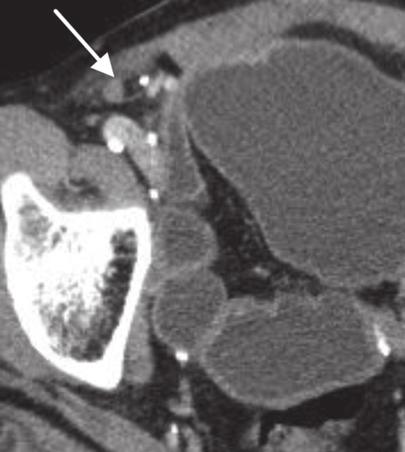 Pitfalls in CT diagnosis of appendicitis Fig. 7.