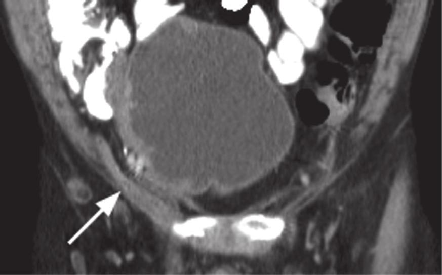 Axial, enhanced CT at a lower level shows increased soft tissue density around the distal appendix (arrow), which