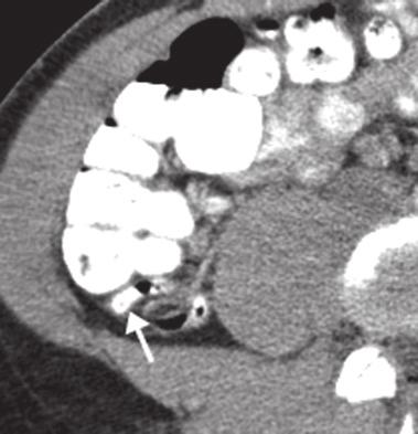 (c) Coronal, enhanced CT shows tubular structure of appendix within the inguinal canal (arrow). (c) Fig. 8.