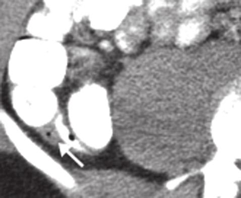Although clinical findings were highly suspicious of acute appendicitis, enhanced axial CT demonstrating the