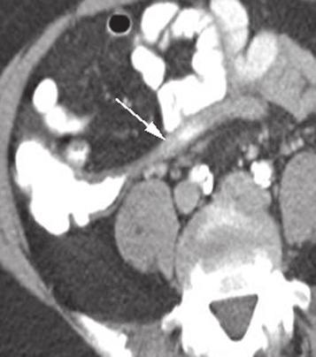 A Shademan and RFR Tappouni Fig. 9. Atypical location of the appendix.