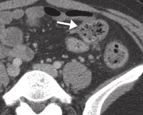 Axial CT with oral and IV contrast shows a dilated thickened appendix crossing the midline into the left lower
