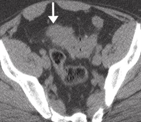 Ileocecal region (arrow) and normal appendix (arrowhead) are seen in the left lower quadrant. (c) (d) Fig. 10.