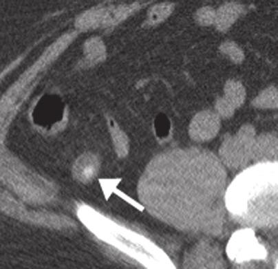 pain and guarding. Enhanced axial CT demonstrates sigmoid diverticulum with stranding (arrow).