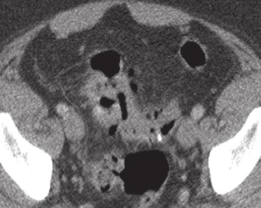 Radiologist suggested that appendiceal changes could be chronic due to mucocele.