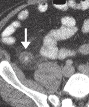 Follow-up enhanced axial CT after 2 days demonstrates resolution of sigmoid diverticulitis.