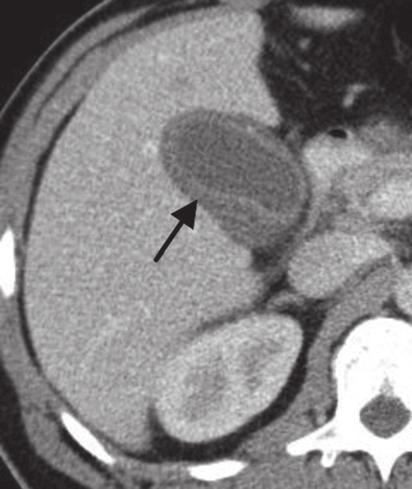 Contrast-enhanced CT shows minimally enlarged appendix (arrow), measuring 8 mm in diameter.