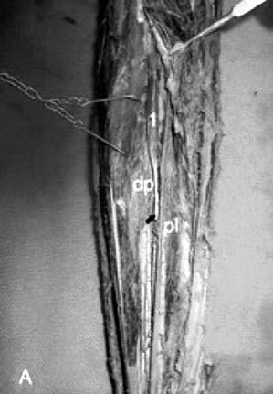 and coronoid process of the ulna (*) and inserting into the upper third (thick arrow) of the flexor pollicis longus (pl) tendon.