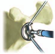 GLENOID PREPARATION GLENOID EXPOSURE A partial capsulotomy and resection of the remaining glenoid labrum are performed to expose the glenoid.