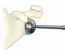 Note: If desired, a trial glenoid sphere of the same diameter as the metaphyseal cup can be screwed into the central hole of the baseplate.