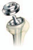 FIXING THE ADAPTOR/METAPHYSIS UNION SCREW The adaptor/metaphysis union screw is screwed into the threaded hole of the cup by hand and