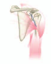 A Hohmann retractor is positioned behind the coracoid. Care should be taken to preserve the origin and insertion of the deltoid.