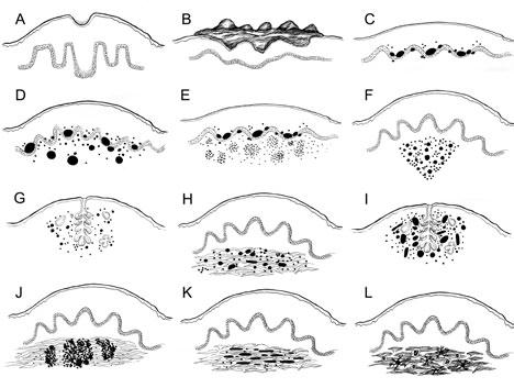 Figure 1. Anatomic patterns of melanocytic nevi. A, Junctional: Single, nested melanocytes at the dermoepidermal junction and lower spinous layer.