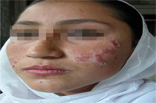 2014-2015 Chronic cutaneous leishmanaisis of face with areas of scarring and reactivation of disease ( recidivans) recidivans due to (L. tropica) from Afghanistan.