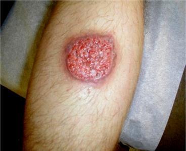 2014-2015 Wet ulcer in CL Cutaneous leishmaniasis caused by L.