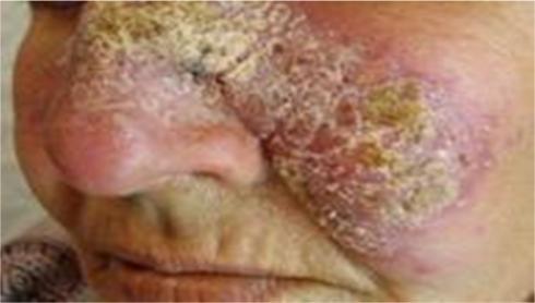 often associated with scaling. This form is known as diffuse cutaneous leishmaniasis.