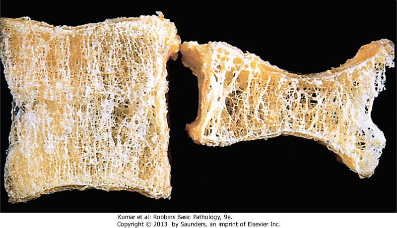 OSTEOPOROTIC VERTEBRAL BODY (RIGHT) SHORTENED BY COMPRESSION FRACTURES, COMPARED WITH A NORMAL VERTEBRAL BODY.