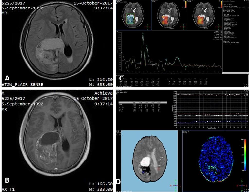 Figure 2: Histopathologically proven case of glioblastoma multiforme. A FLAIR axial image showing heterogenous solid-cystic lesion in parasagittal location of the right parieto-occiptal lobes.