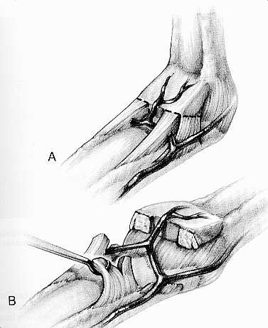 Interphalangeal joint: check rein ligaments Swallowtail extensions of