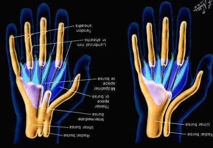 Synovial sheaths of the palm In 50% there is a communication