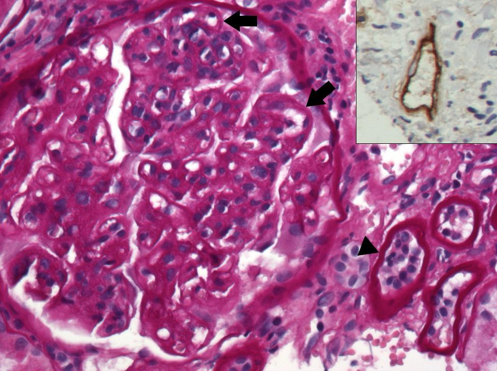 Chronic Antibody-mediated rejection Glomerular double contours, and/or peritubular capillary