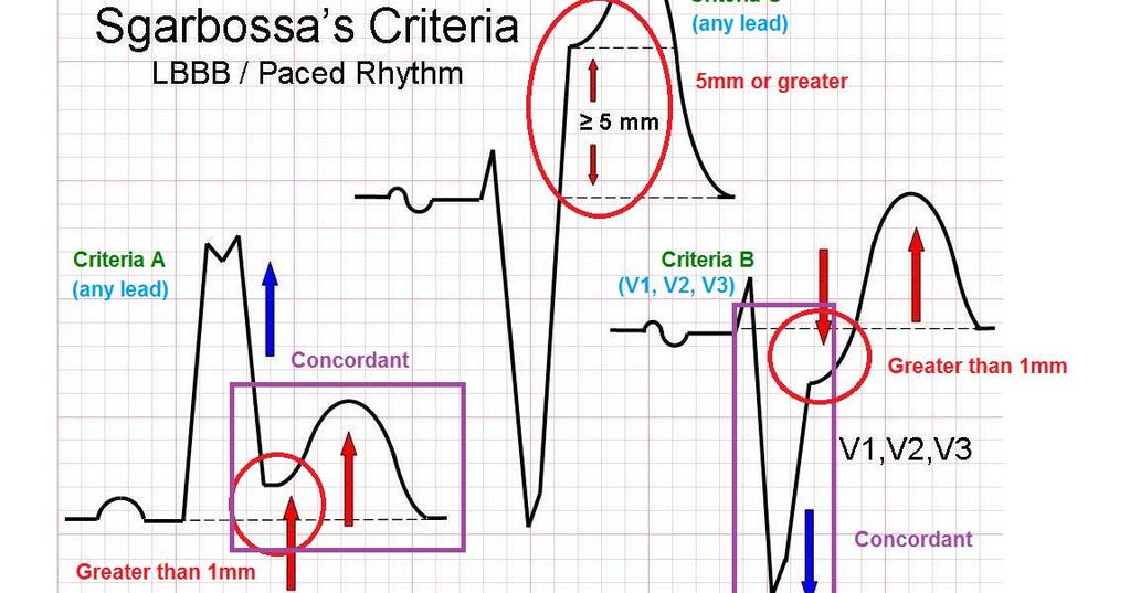 LBBB and